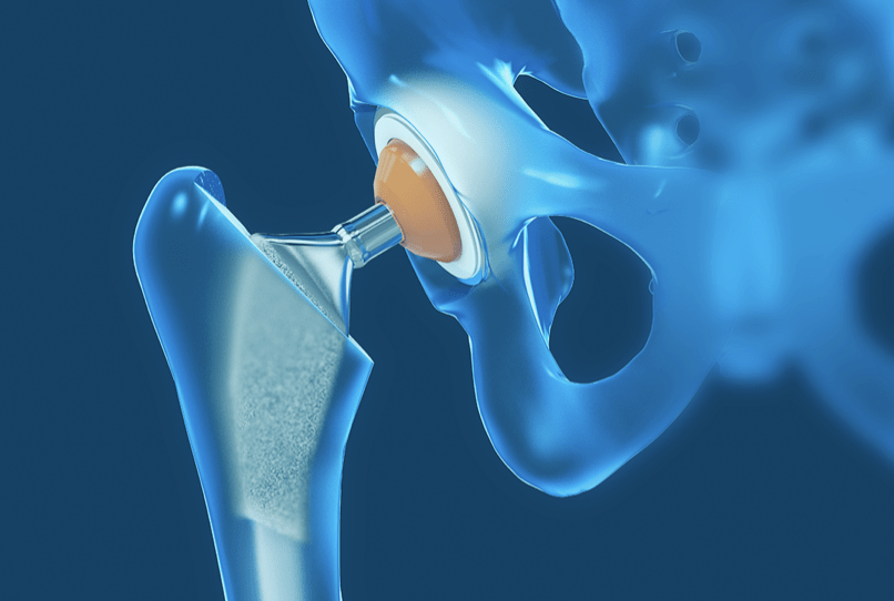 Prótese da anca - modelo 3D